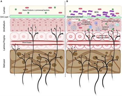 BCG induced lower urinary tract symptoms during treatment for NMIBC—Mechanisms and management strategies